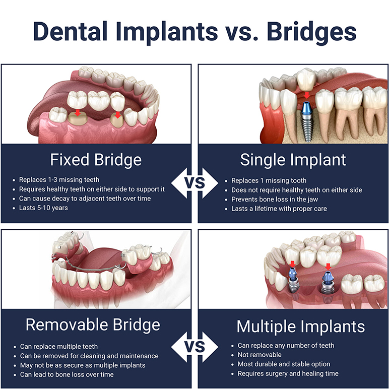 dental bridge implant