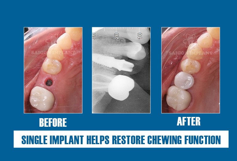 single implants before after