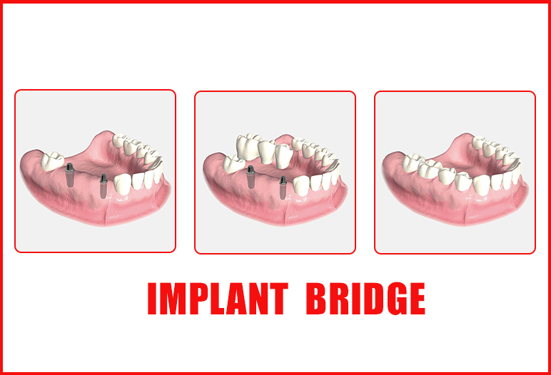 dental implant
