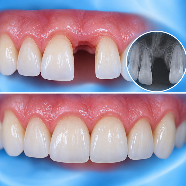 missing front tooth
