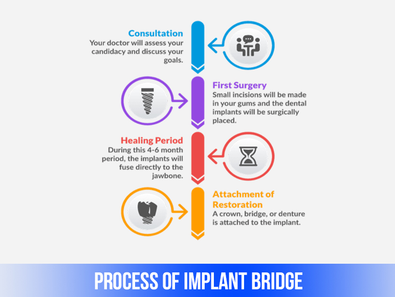 process of dental bridge implant