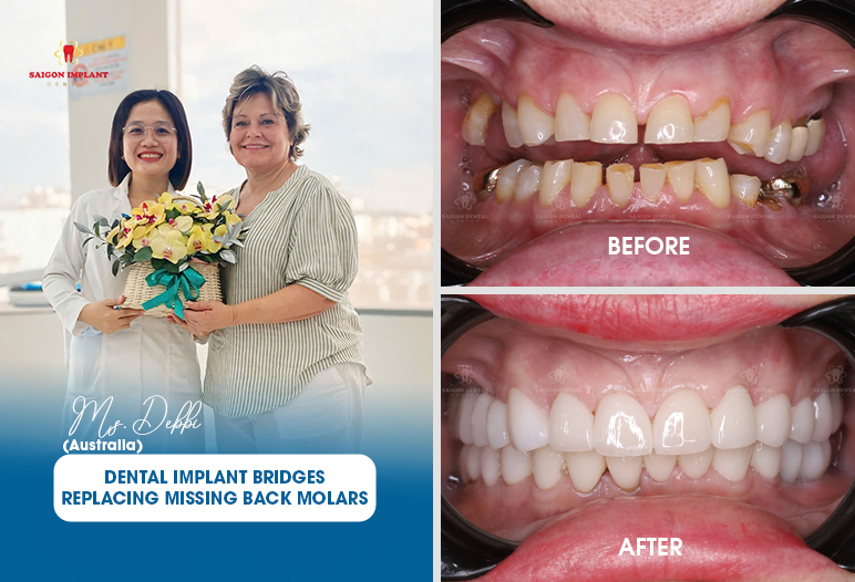 Replacing Missing Back Molars replacing missing back molars