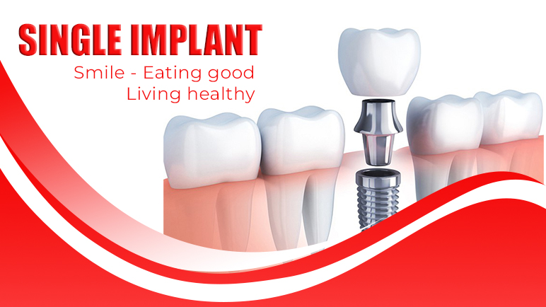 SINGLE IMPLANT AT SAIGON IMPLANT DENTAL CLINIC - Saigon Implant Dental ...