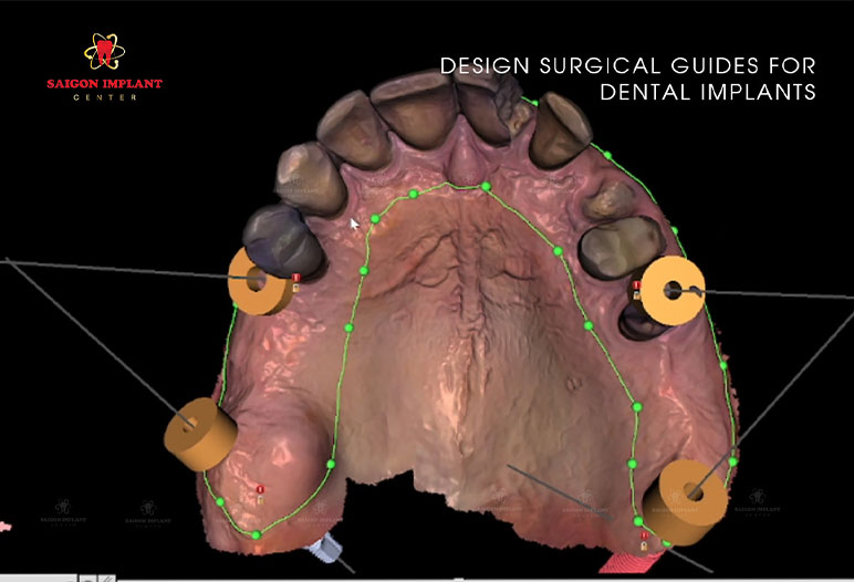 surgical guide implants