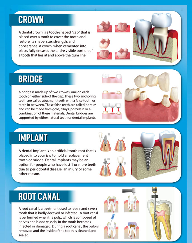 Dental Crown: Types, Procedure and Cost - Saigon Dental Implants Center ...