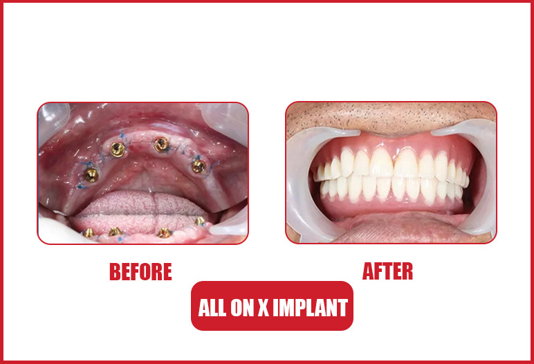 all on 4 implant before after