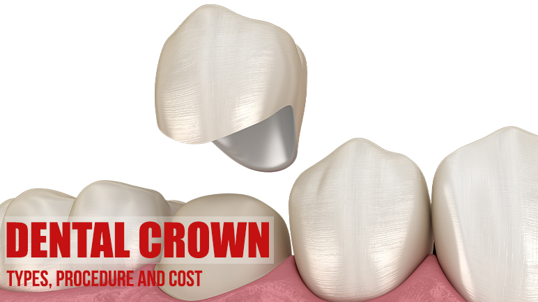 Dental Crowns: Types, Procedure & Care