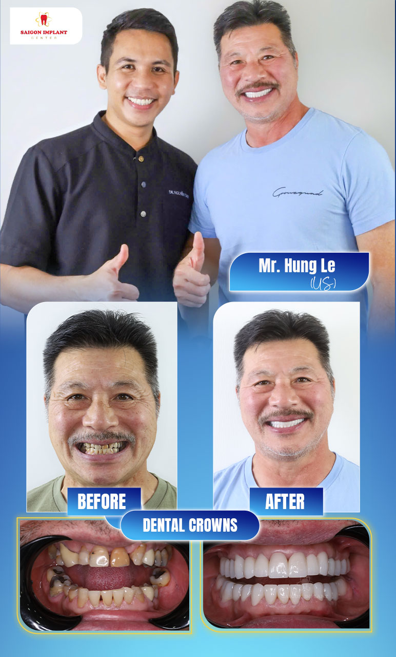 getting dental crowns in vietnam