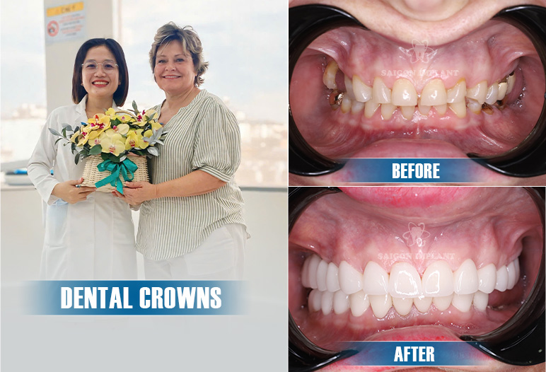 dental crowns before and after image