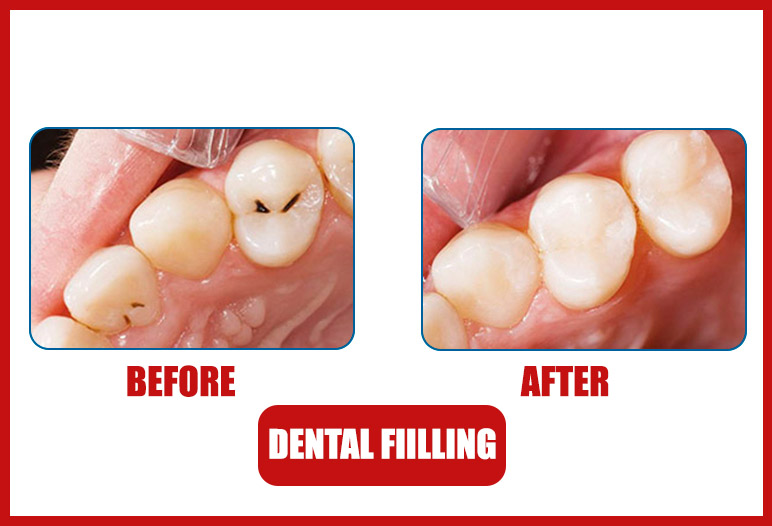 tooth filling before after