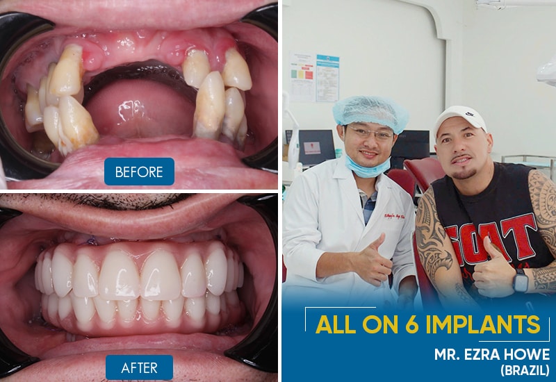 Full-Arch Implant Placement at Saigon Dental Implants Center