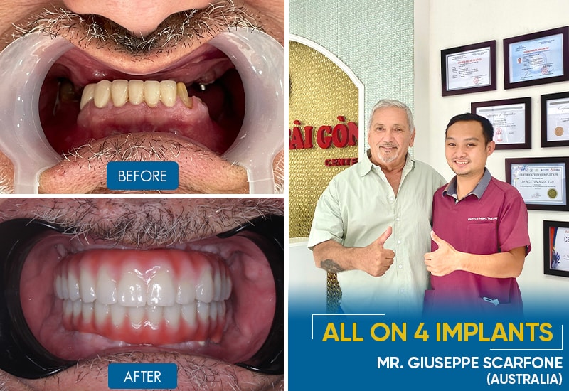 before and after all on 4 dental implants