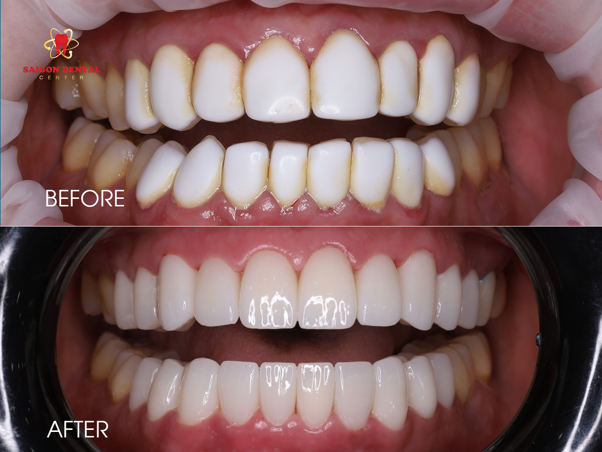Dental Veneers 1 best cosmetic dentistry