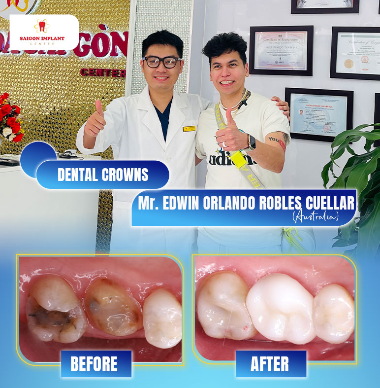 root canal treatment