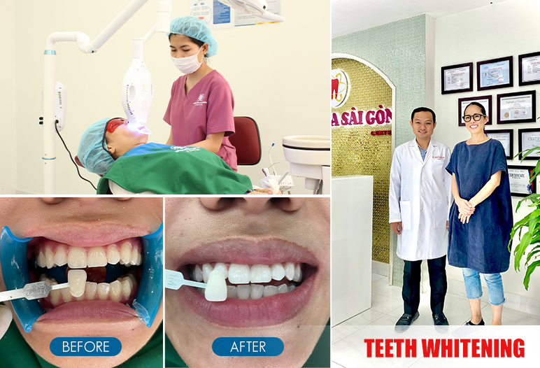 Teeth whitening before after