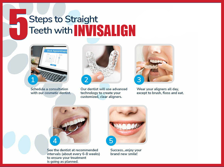 5 step invisalign dental braces