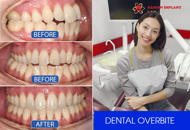 Before and after over bite teeth braces images