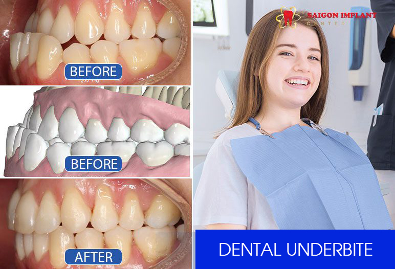 Before and after underbite teeth braces images