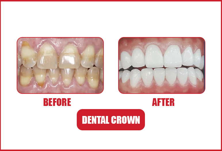 dental crown before after image