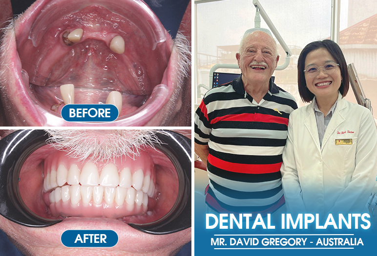 full mouth dental implants before after