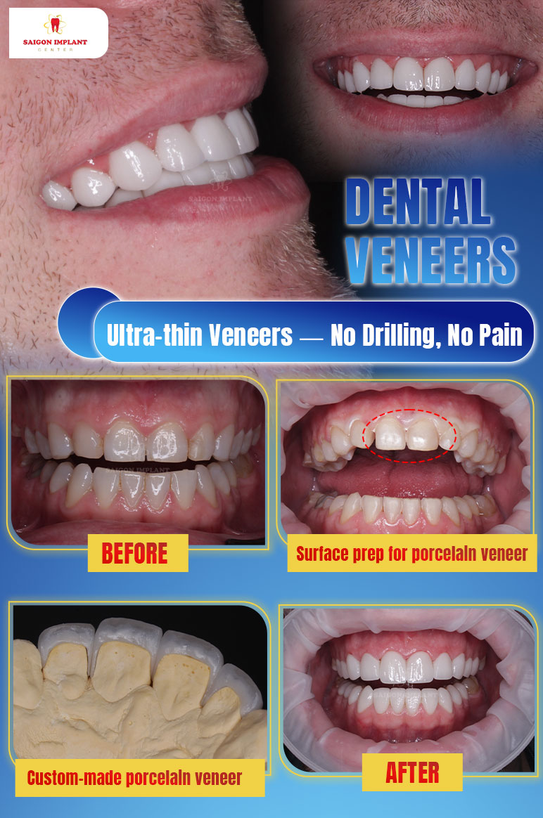 getting dental veneers in vietnam