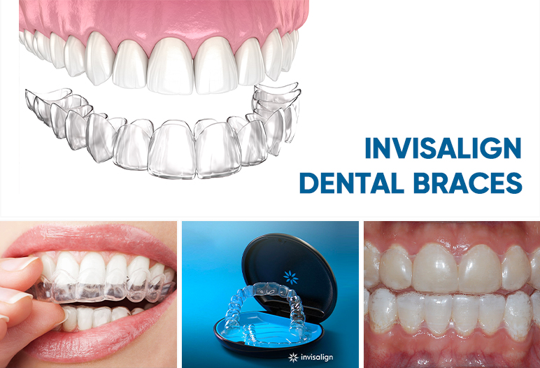 invisalign dental braces in vietnam