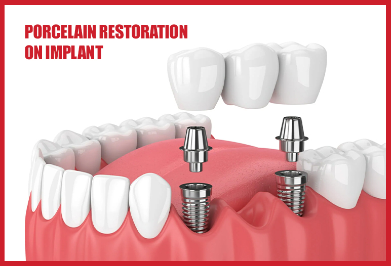 porcelain restoration on implant