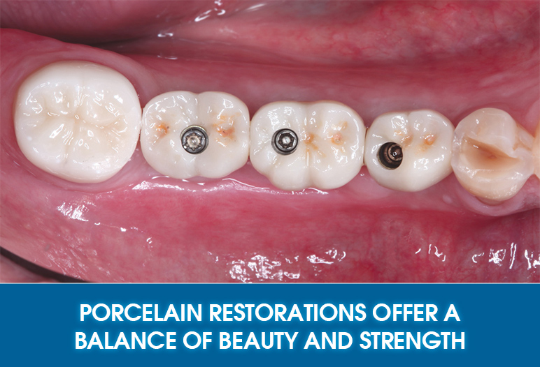 porcelain crown on implants