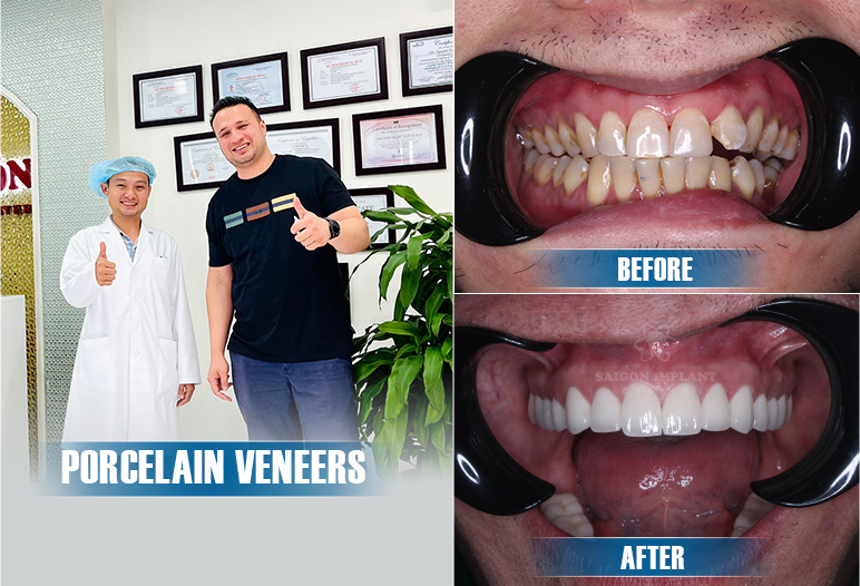 Veneer crowns improve discolored teeth