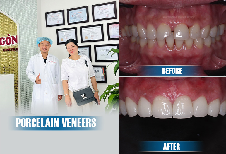 best dental veneers in vietnam