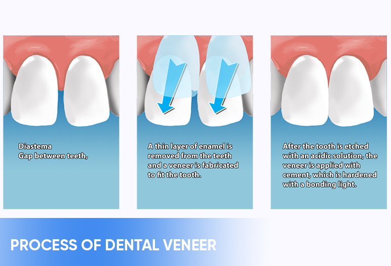 process of porcelain veneer