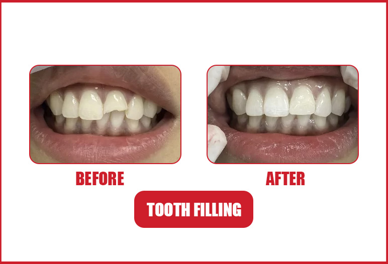 dental filling before after image