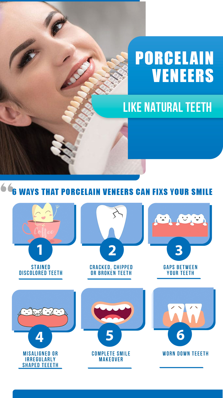 way of dental veneer fix