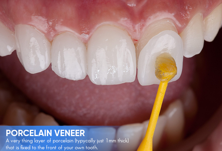 what's dental veneer