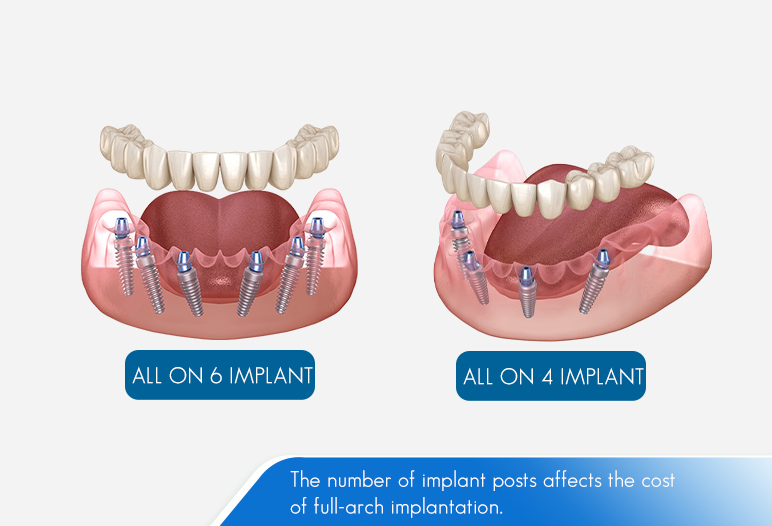 all on x implant