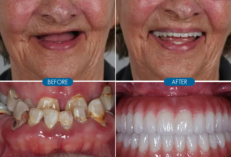 full mouth dental implant before and after image