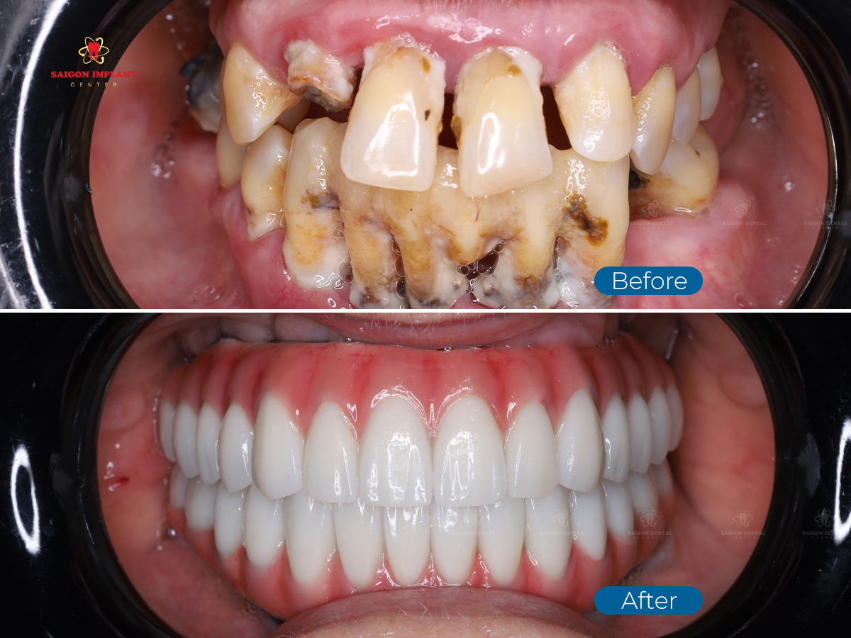 Best Dental Restoration Clinic In Ho Chi Minh full-mouth dental implant for periododontist case