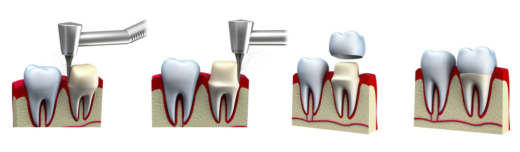 Dental Crown Procedure