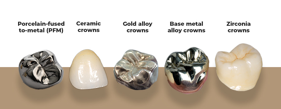 Comprehensive Guide to Dental Crowns