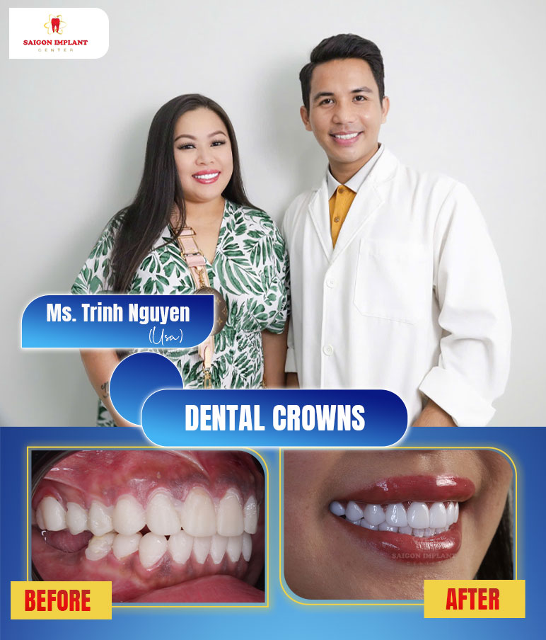 getting dental crowns in vietnam
