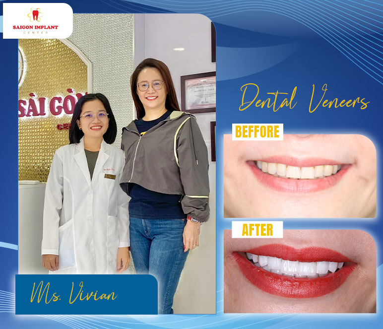 getting dental veneer in vietnam