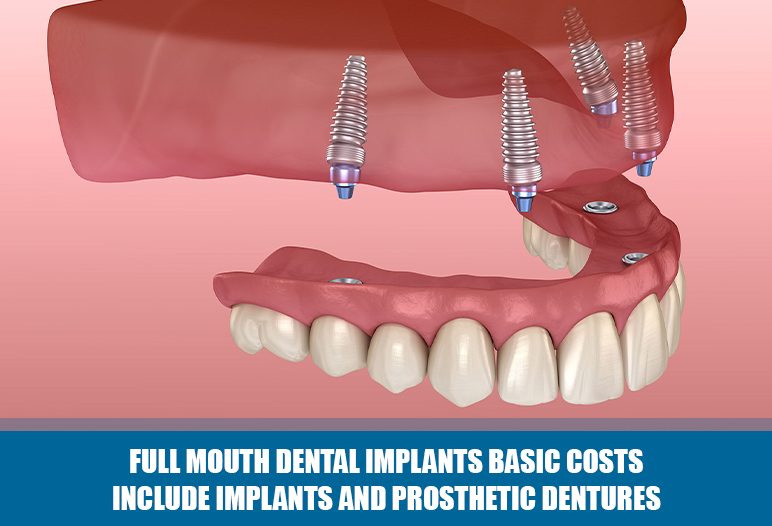 the cost of full mouth dental implants