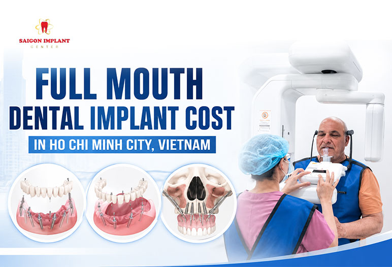 Full Mouth Dental Implant Cost 2026 Full mouth Dental Implant cost