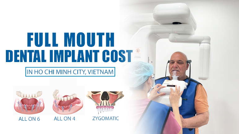 full mouth dental implant cost