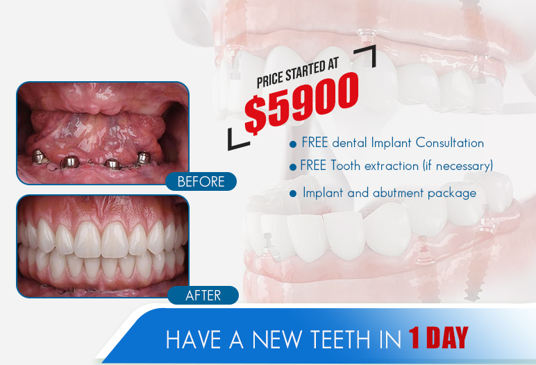 full mouth dental implant cost