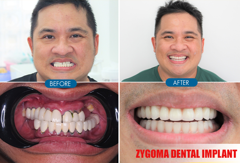 Zygoma Implants for Upper Jaw: Advantages, Benefits, Procedure, Cost ...