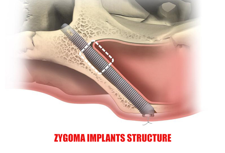 zygoma implants structure