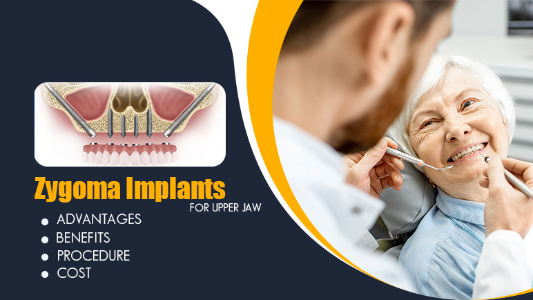 Zygoma implants