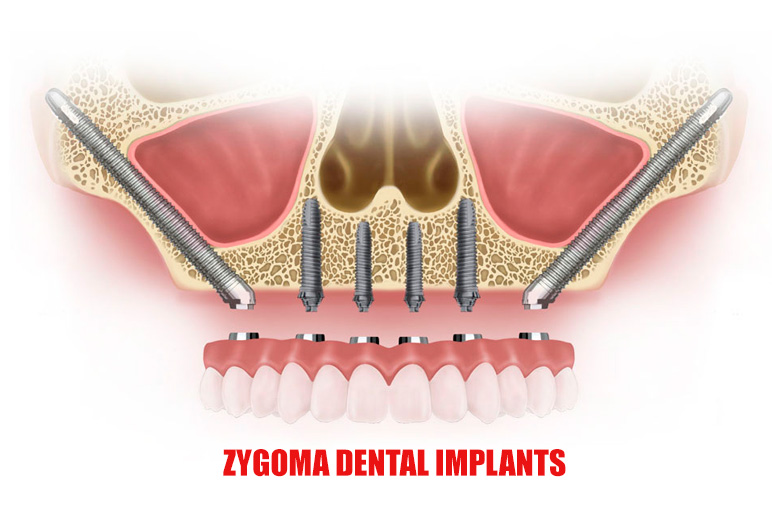 Zygoma implants