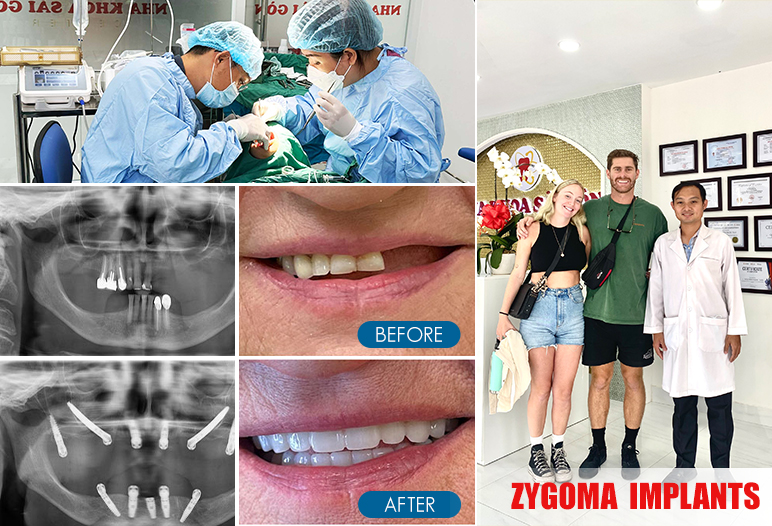 zygomatic dental implants